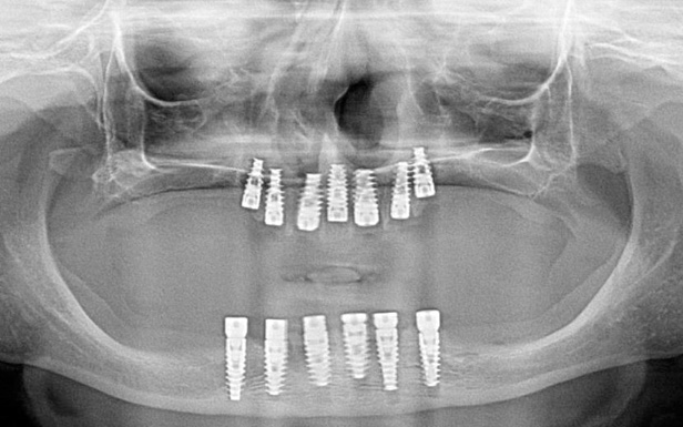 Full Mouth Rehabilitation in a young patient with Ectodermal Dysplasia